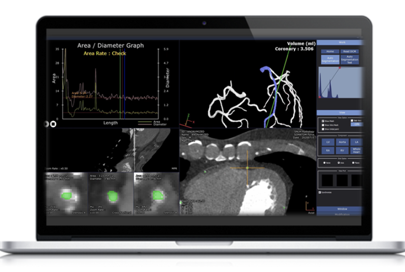 AI-based Cardiac CT Image Three-dimensional Analysis Fully